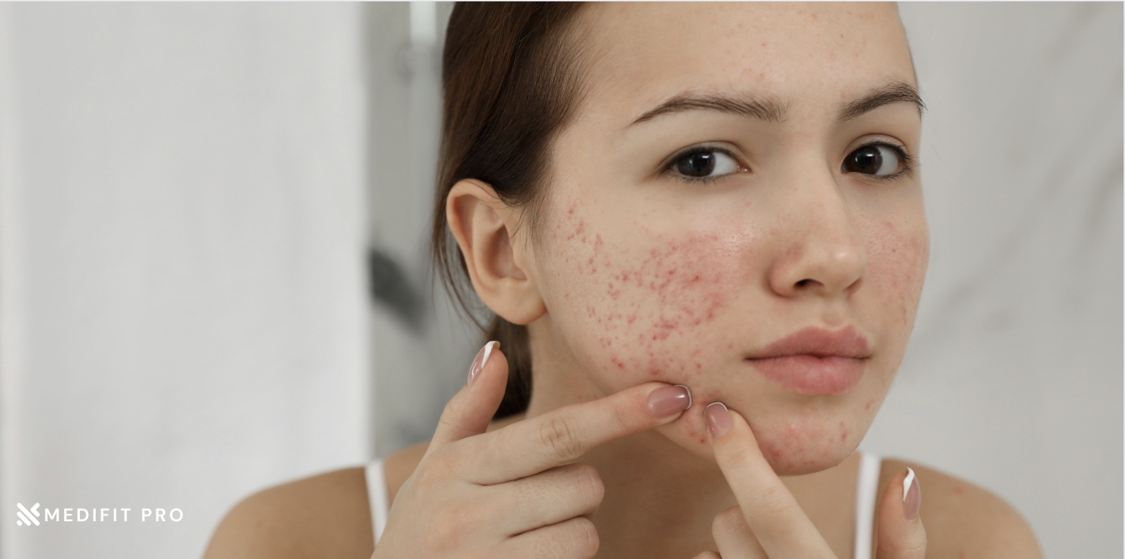 Say Goodbye To Acne A Comprehensive Guide Medifitpro