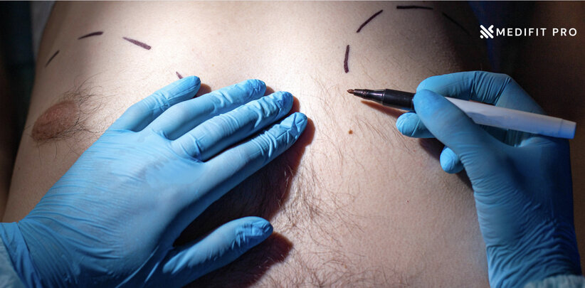 Gynecomastia surgery 