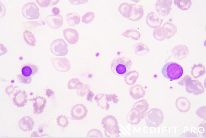 Microscopic slide of anemia