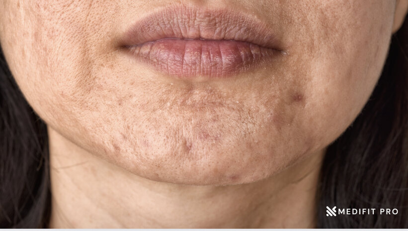 Adult female acne scarring Medifitpro.com