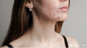 Adult female acne Medifitpro pro.com