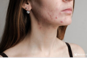 Adult female acne Medifitpro pro.com